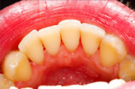 Gum Disease After