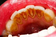 Gum Disease Before